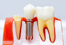 dental implant placement