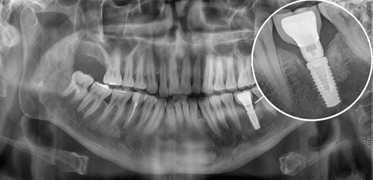 implant for the missing tooth