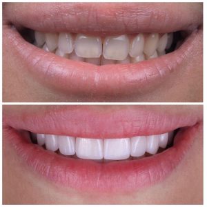 Dental Veneers Turkey